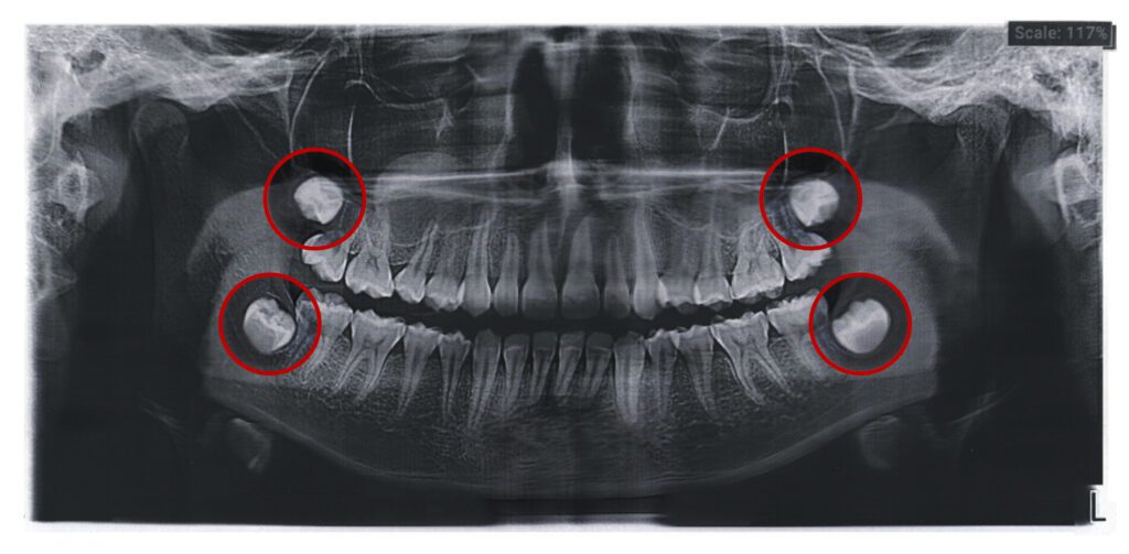 Wisdom Teeth Removal Before Orthodontic Treatment - MyOrthodontist - oral surgery,wisdom teeth removal oral surgery in west orange