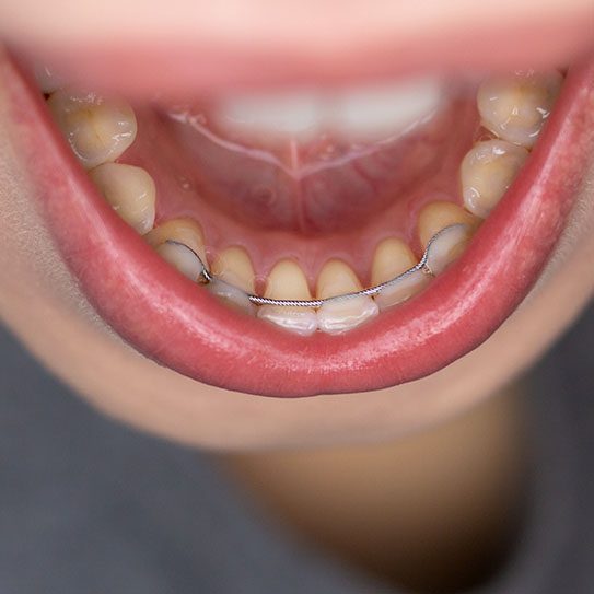 What Goes into Maintaining My Braces Results? - MyOrthodontist - braces Cherry Hill retainers