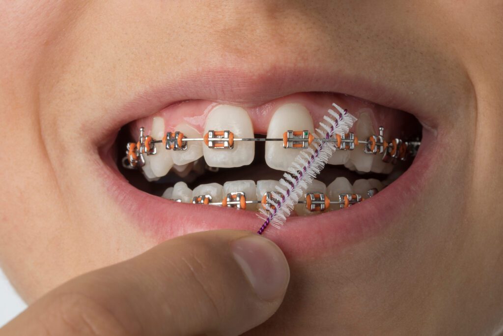 5 Powerful Tips for Braces Aftercare: Essential Hygiene for a Healthy Smile - MyOrthodontist - braces aftercare