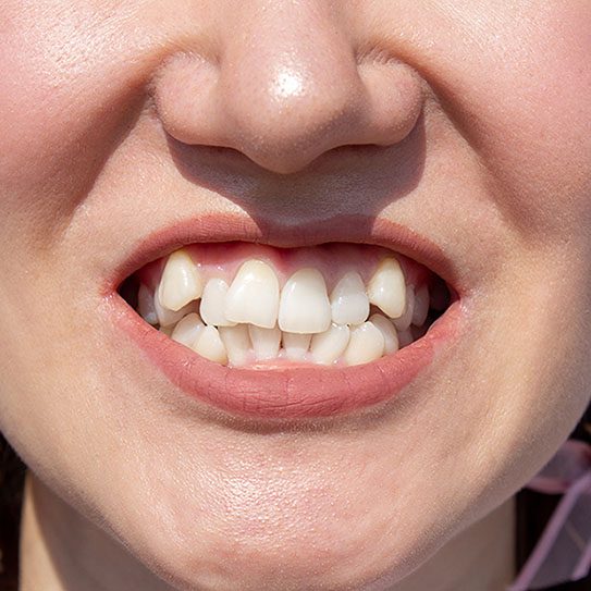 Why Did My Teeth Grow In Crooked? - MyOrthodontist - affordable orthodontist,affordable Invisalign MyOrthodontist -