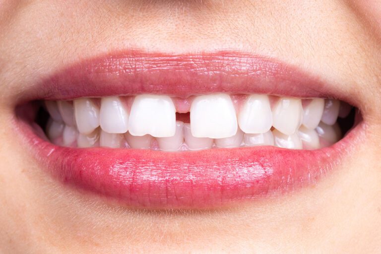 Upper Anterior Touch-Ups - MyOrthodontist - upper anterior touch-up,teeth alignment,tooth gap upper anterior touch-up teeth alignment tooth gap