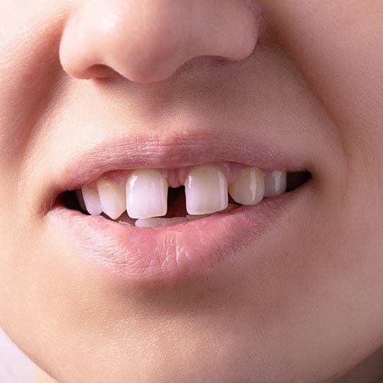Is There a Treatment Focused on Fixing Gaps in Teeth? - MyOrthodontist - Invisalign,Invisalign care straight teeth fixing gaps in teeth upper anterior touch-ups