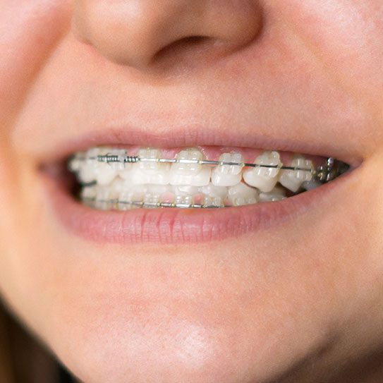 It's Never Too Late to Correct Your Smile With Invisalign - MyOrthodontist - Invisalign,Invisalign care Invisalign clear braces