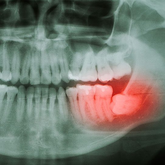 When Is Wisdom Tooth Removal Recommended? - MyOrthodontist - Invisalign,Invisalign care wisdom tooth removal wisdom teeth removal orthodontist