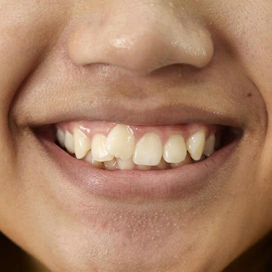 Crooked Teeth and More: Why Treat Orthodontic Issues? - MyOrthodontist - Crooked teeth,smile repair Crooked teeth smile repair