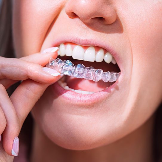 Everything to Know About the Invisalign Process - MyOrthodontist - invisalign invisalign