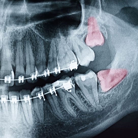 Wisdom Teeth: When Is Oral Surgery the Solution? - MyOrthodontist - oral surgery,wisdom teeth removal oral surgery wisdom teeth removal