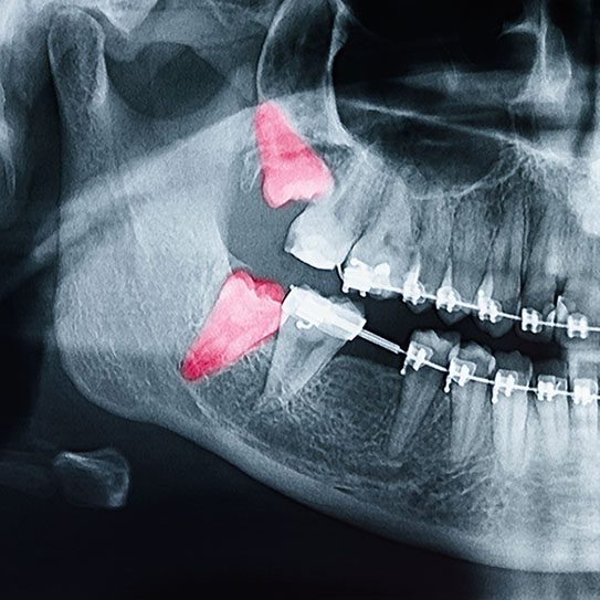 Orthodontic Treatment and Wisdom Teeth - MyOrthodontist - MyOrthodontist -