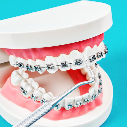 With Affordable Braces, Should I Consider Orthodontic Treatment? - MyOrthodontist - affordable braces,affordable braces near me,braces affordable braces near me