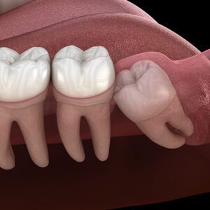 wisdom teeth removal oral surgery
