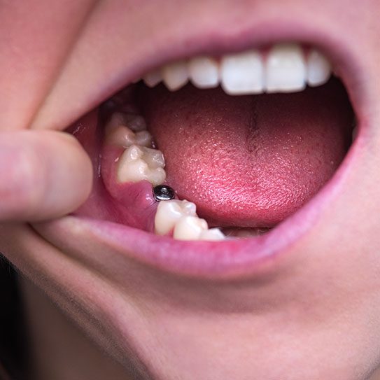 Dental Implants: Your Guide to Placement - MyOrthodontist - dental implants