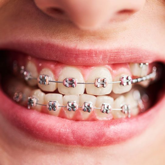 Pros and Cons of Braces and Invisalign - MyOrthodontist - braces West New York orthodontist Invisalign