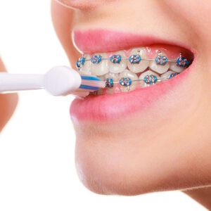 Orthodontics Blog - MyOrthodontist - braces Lawrenceville orthodontist Invisalign