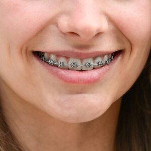 Orthodontics Blog - MyOrthodontist - braces deptford invisalign deptford orthodontist deptford