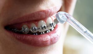 Orthodontics Blog - MyOrthodontist - braces near me orthodontist Deptford