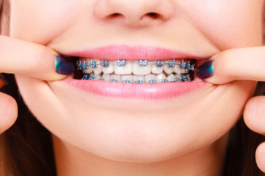 November Is the Perfect Time to Start Your Braces Journey - MyOrthodontist - braces invisalign orthodontist Paterson nj