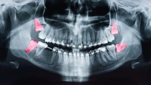 Orthodontics Blog - MyOrthodontist - orthodontist in West Orange wisdom teeth removal orthodontics