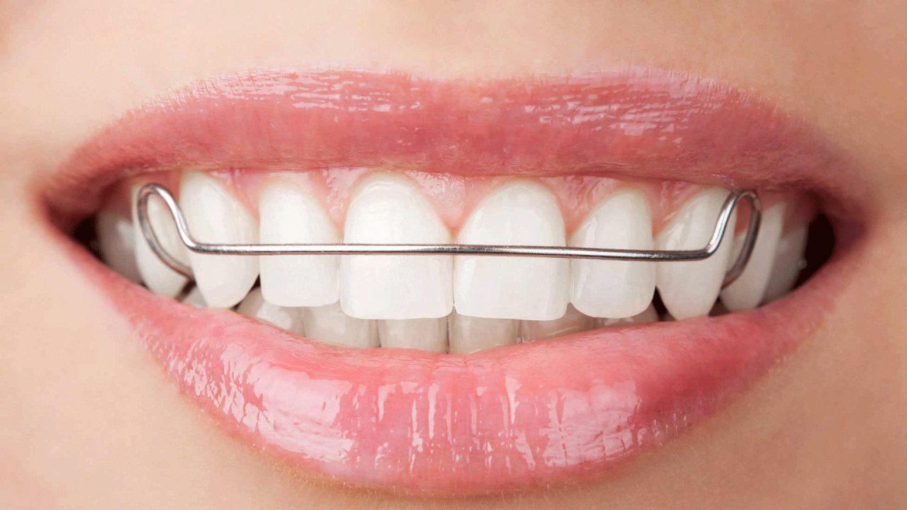 Who Counts as a Braces Specialist? Orthodontists Vs. Dentists - MyOrthodontist - braces specialist braces in Deptford Township